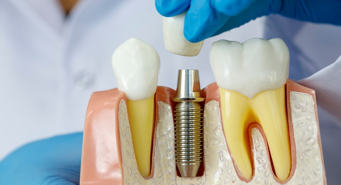 Ce este și cât costă un implant dentar_ 2