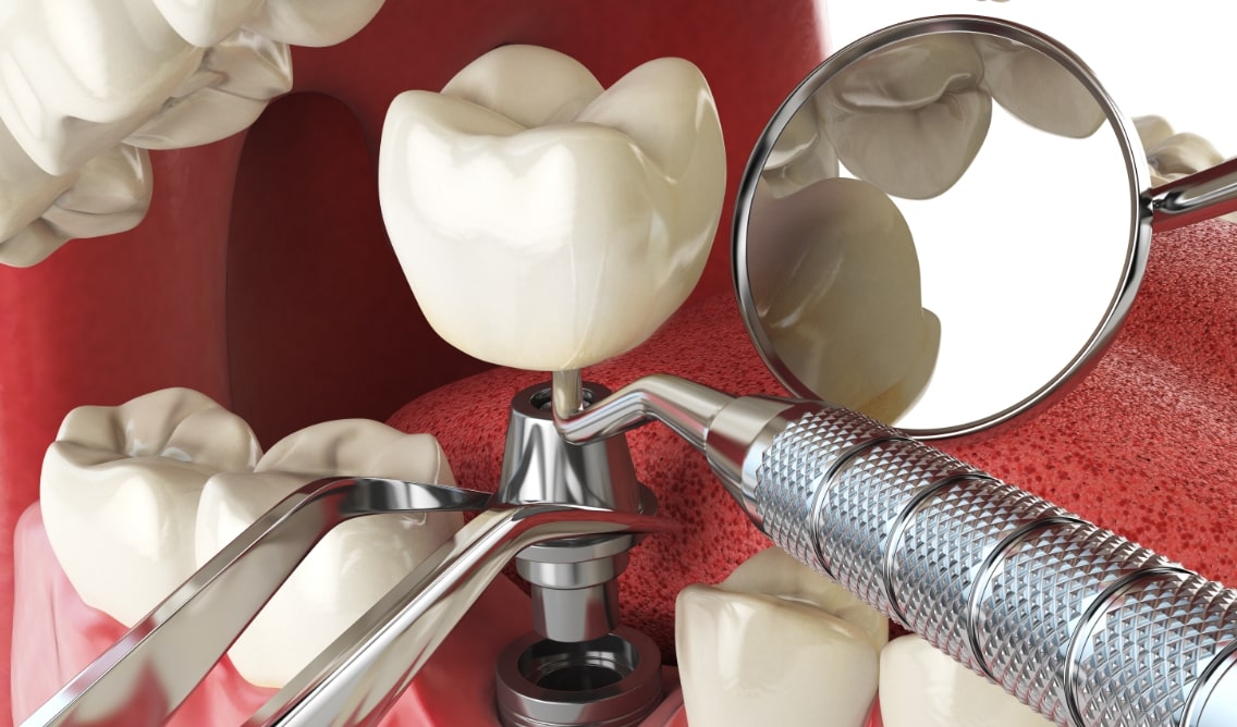 Ce este și cât costă un implant dentar_ 3
