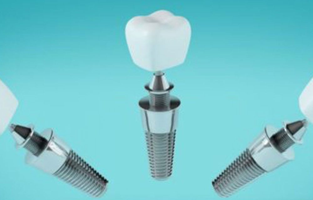 Implanturi dentare: tipuri, etape și avantaje