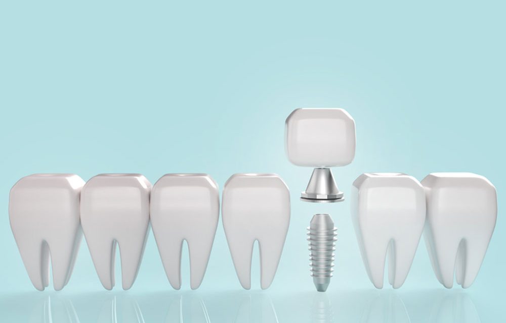 Sinus lift înainte de implantul dentar: când este necesar și ce beneficii are?