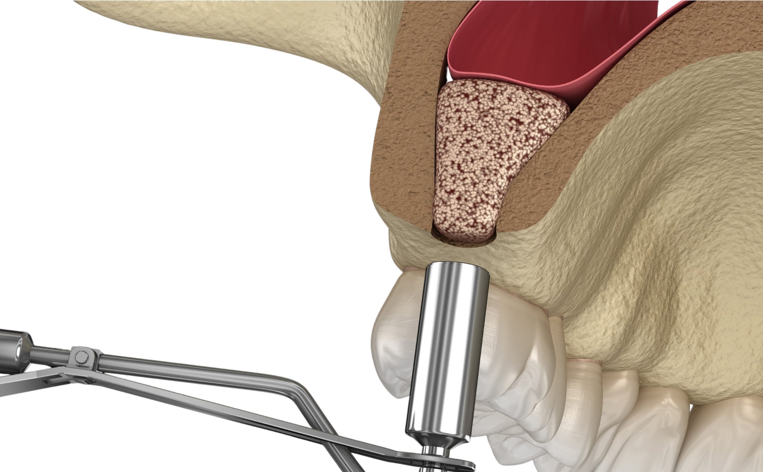Sinus lift înainte de implantul dentar când este necesar și ce beneficii are_ 3