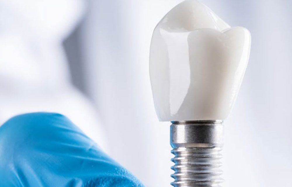 Ce este și cât costă un implant dentar?