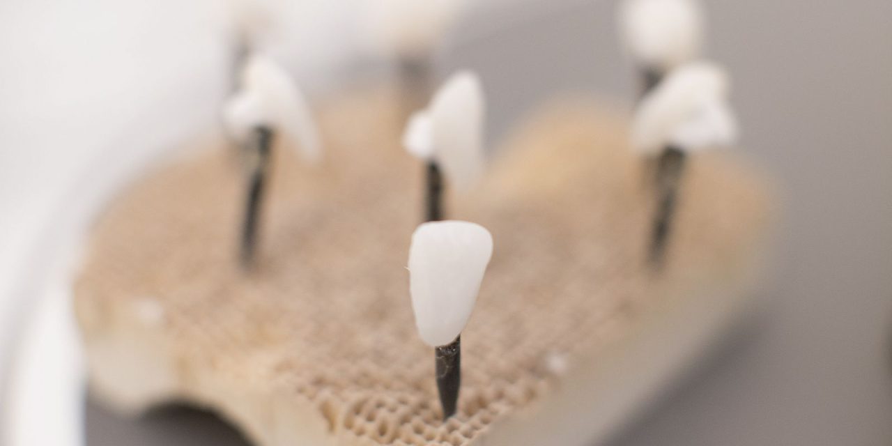 Cât costă o fațetă dentară și ce implică procesul de aplicare?