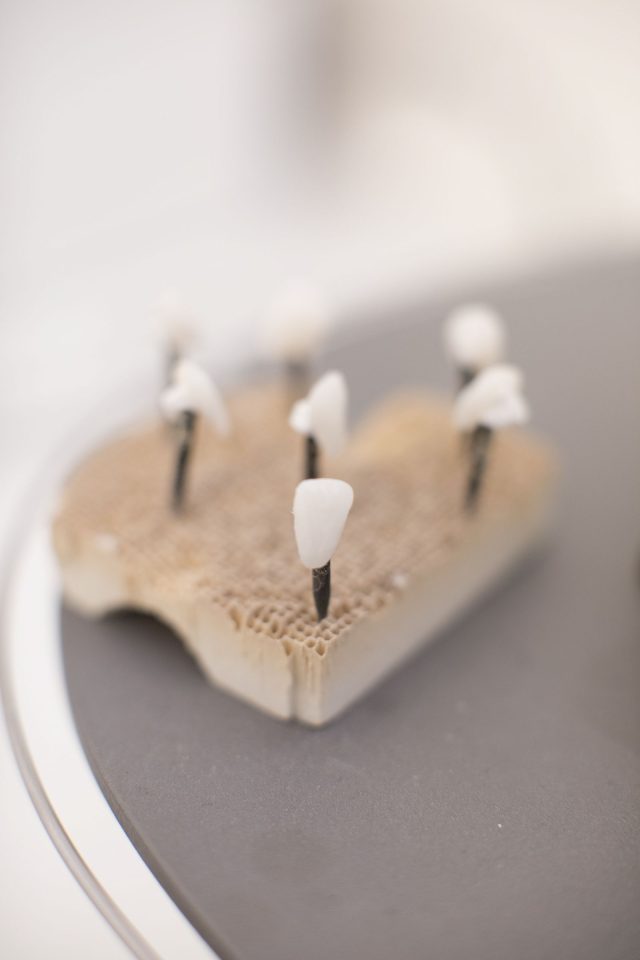 cât costă o fațetă dentară