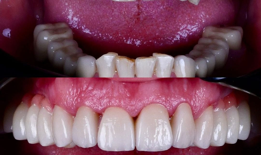 Etapele implantului dentar