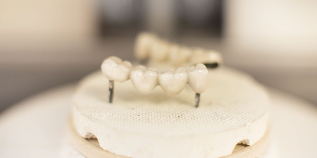 Tipuri de coroane dentare – cum alegi cea mai potrivită variantă?