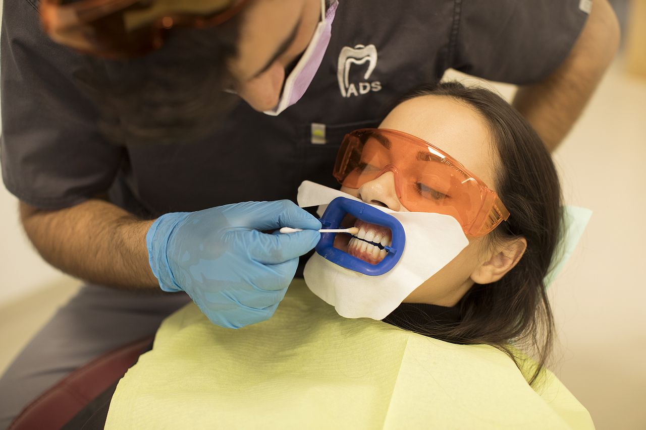 Avantaje și dezavantaje ale albirii dentare profesionale