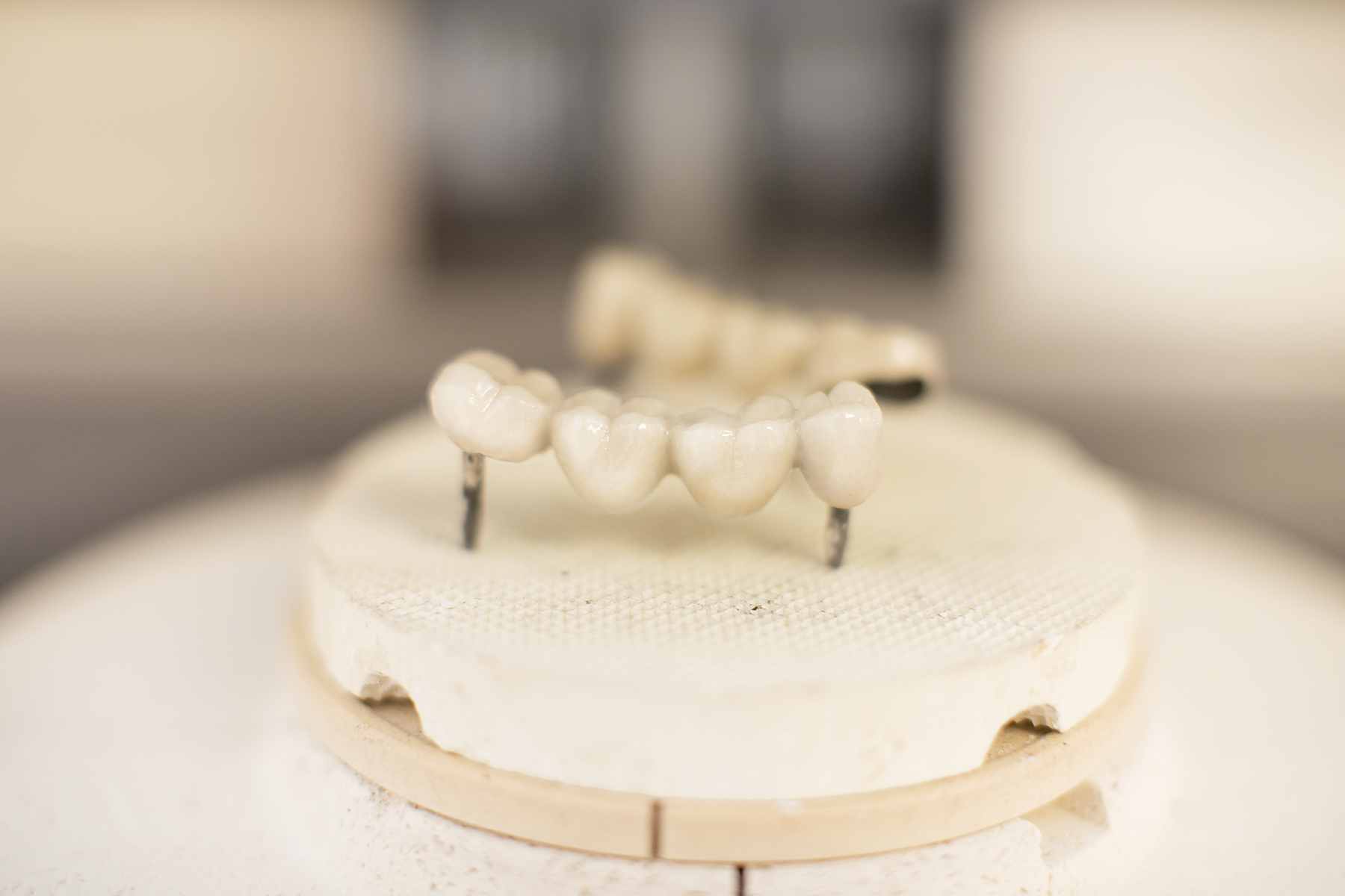 Când să alegi proteza fixă fără implant (4)
